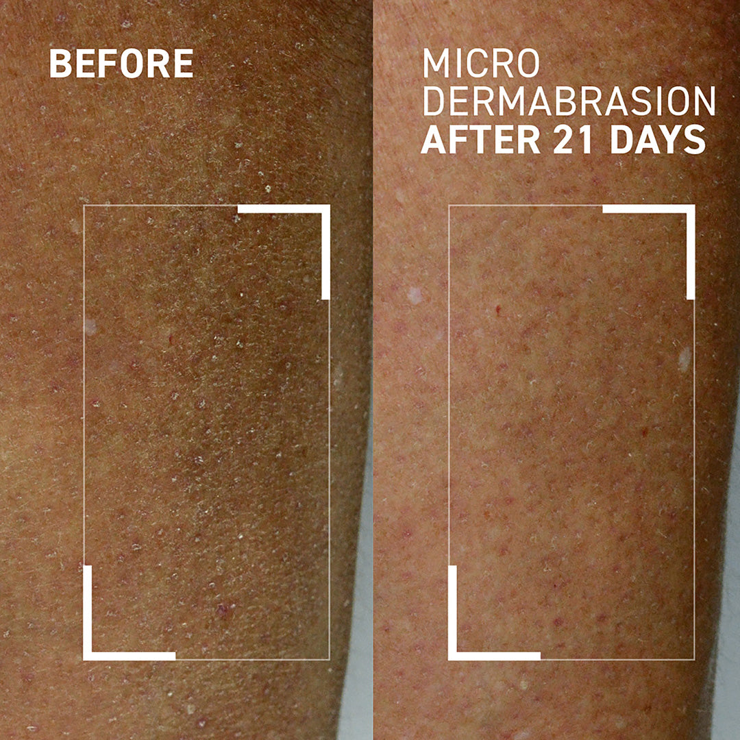 Microdermabrasion Facial at Home