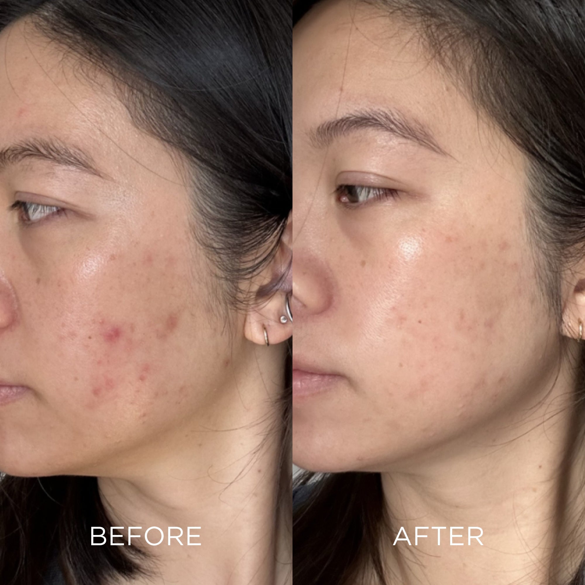 Hyaluronic Acid for Acne-Prone Skin