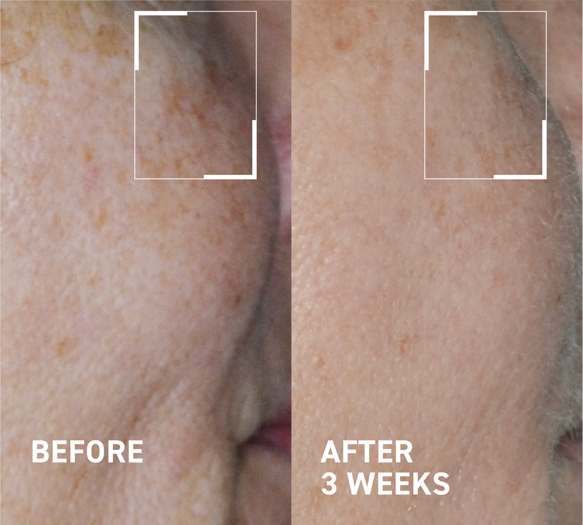 Hyperpigmentation & Melasma Routine