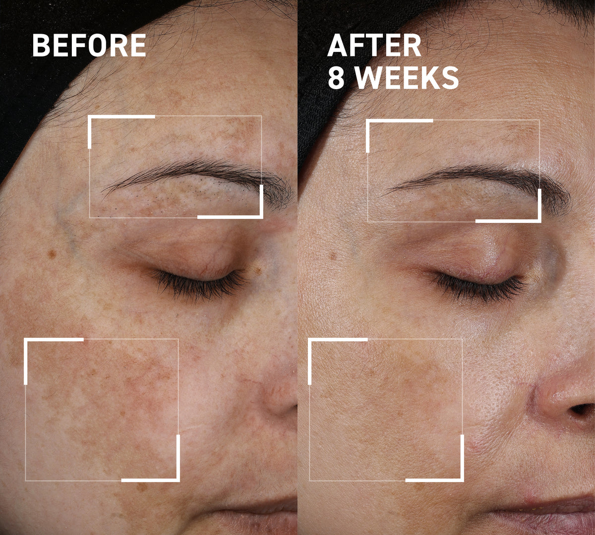 Hyperpigmentation & Melasma Routine