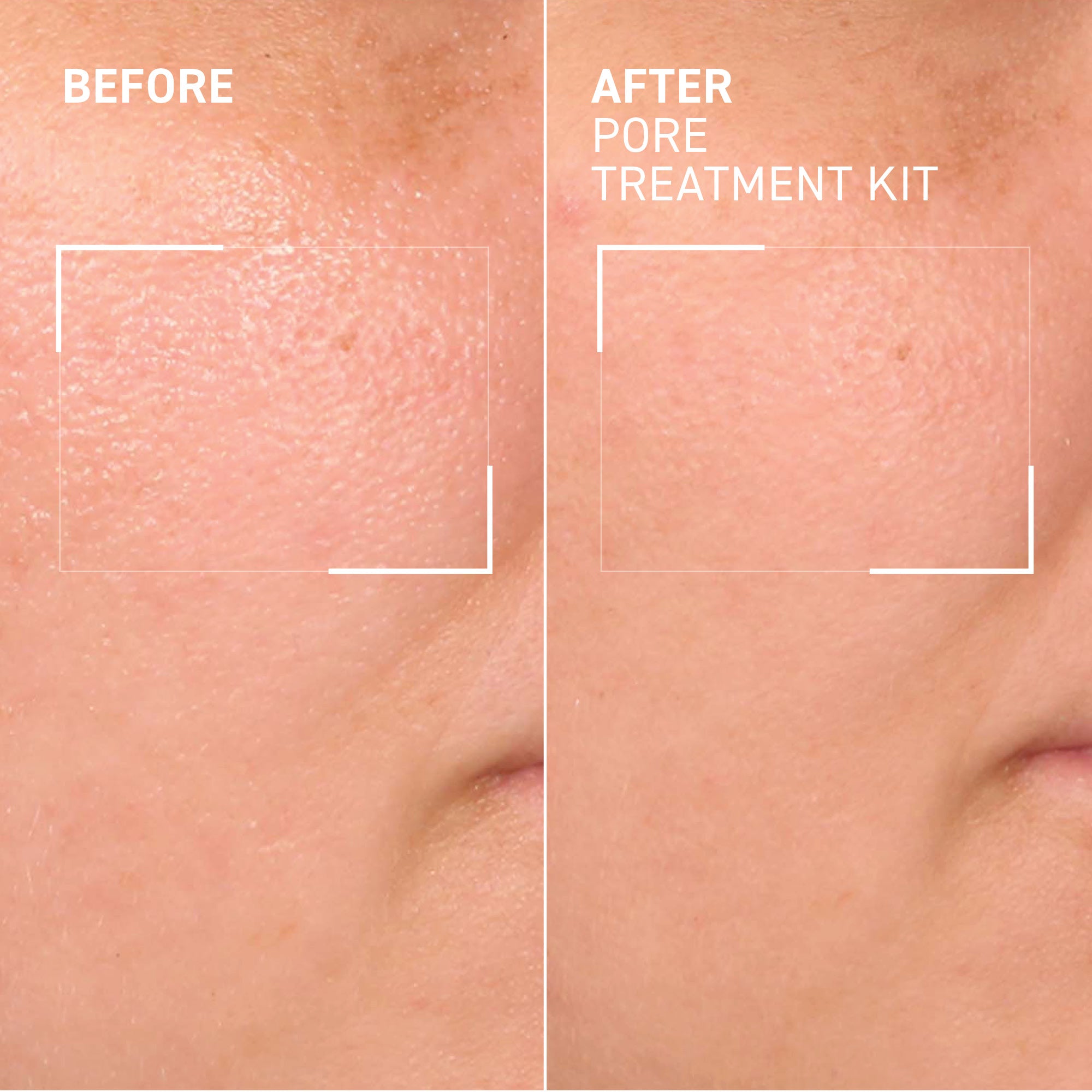 Pore Refining Treatment Kit