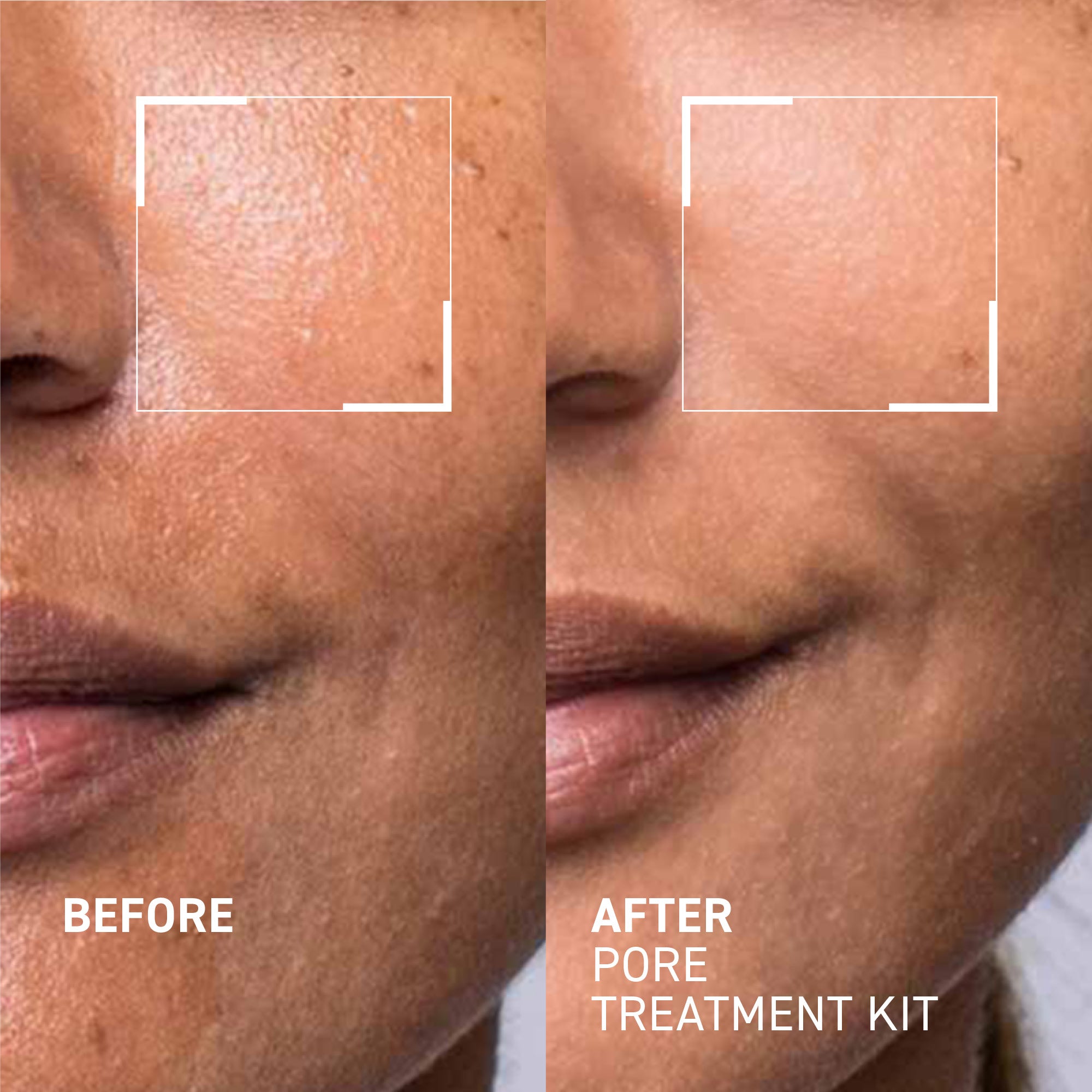 Pore Refining Treatment Kit