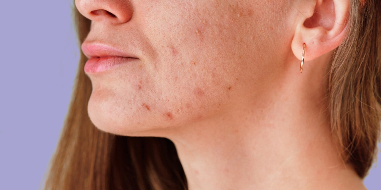 Menopause Acne Treatment
