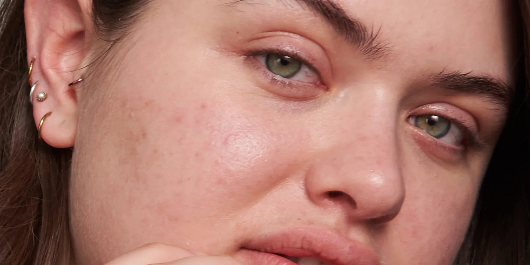 Blemishes