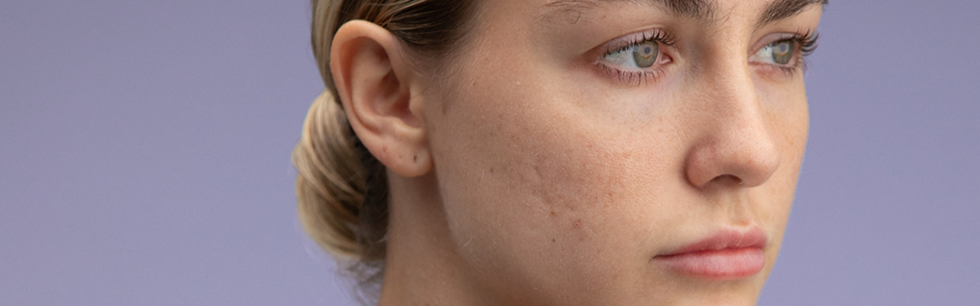 Acne and Blemish Cream