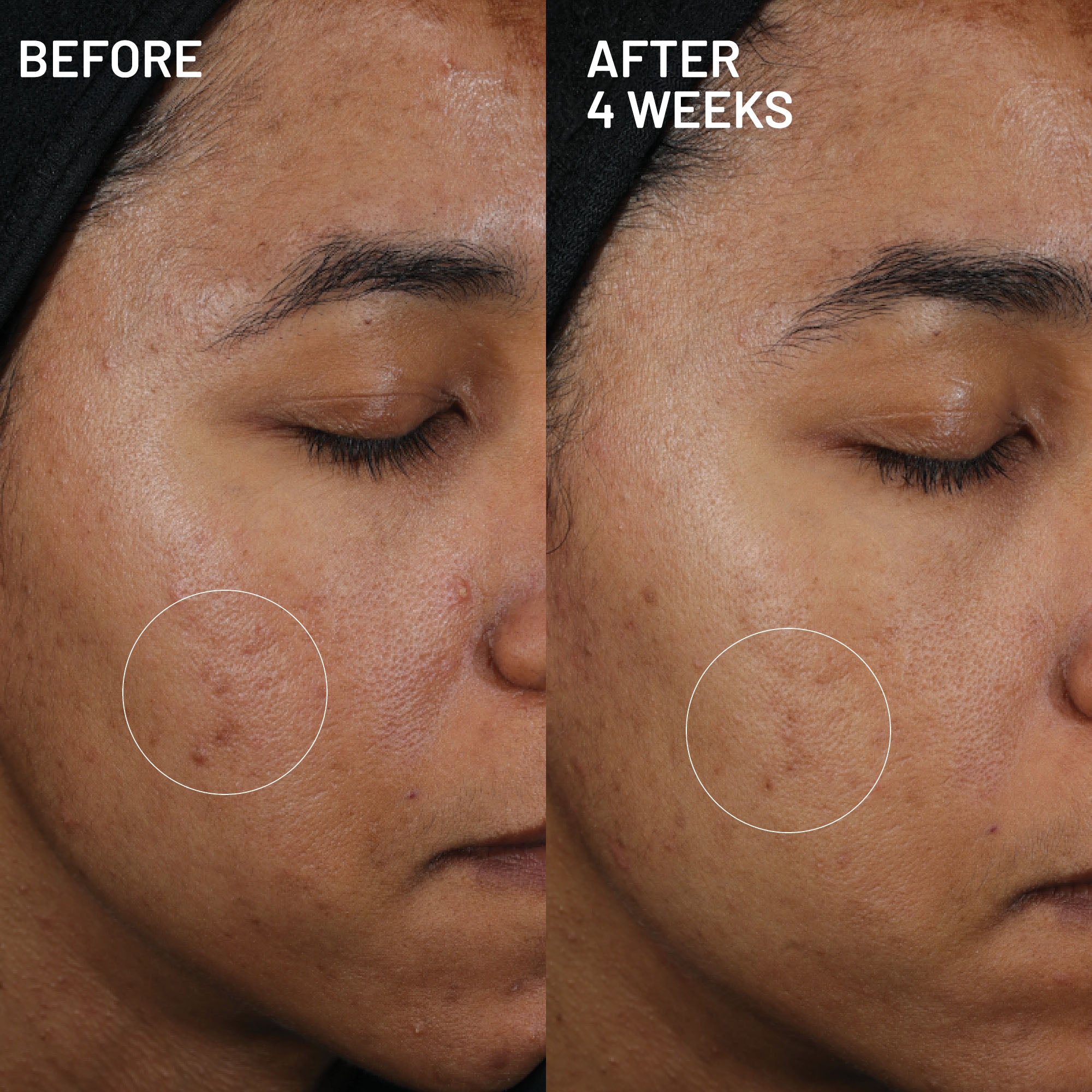 Hyperpigmentation & Melasma Routine