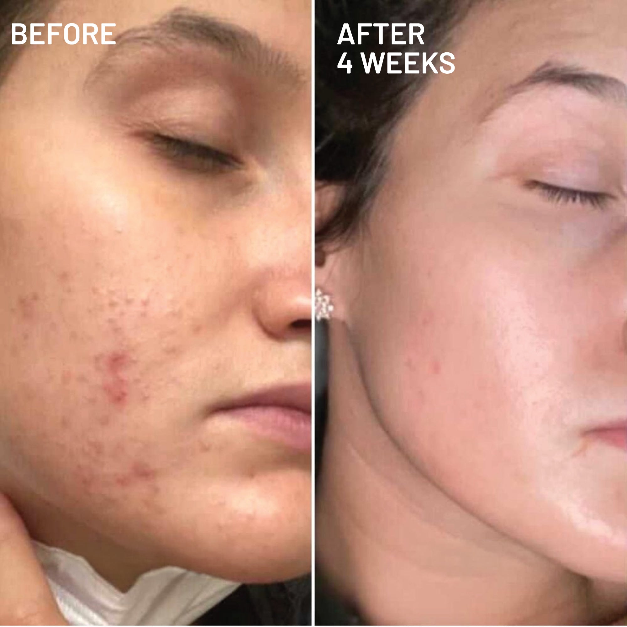 Hyperpigmentation & Melasma Routine