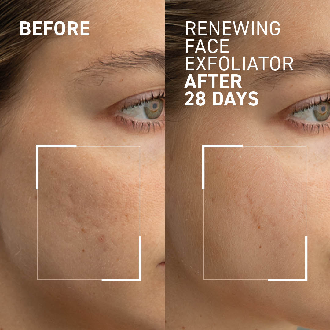Gentle Microdermabrasion Face Exfoliator