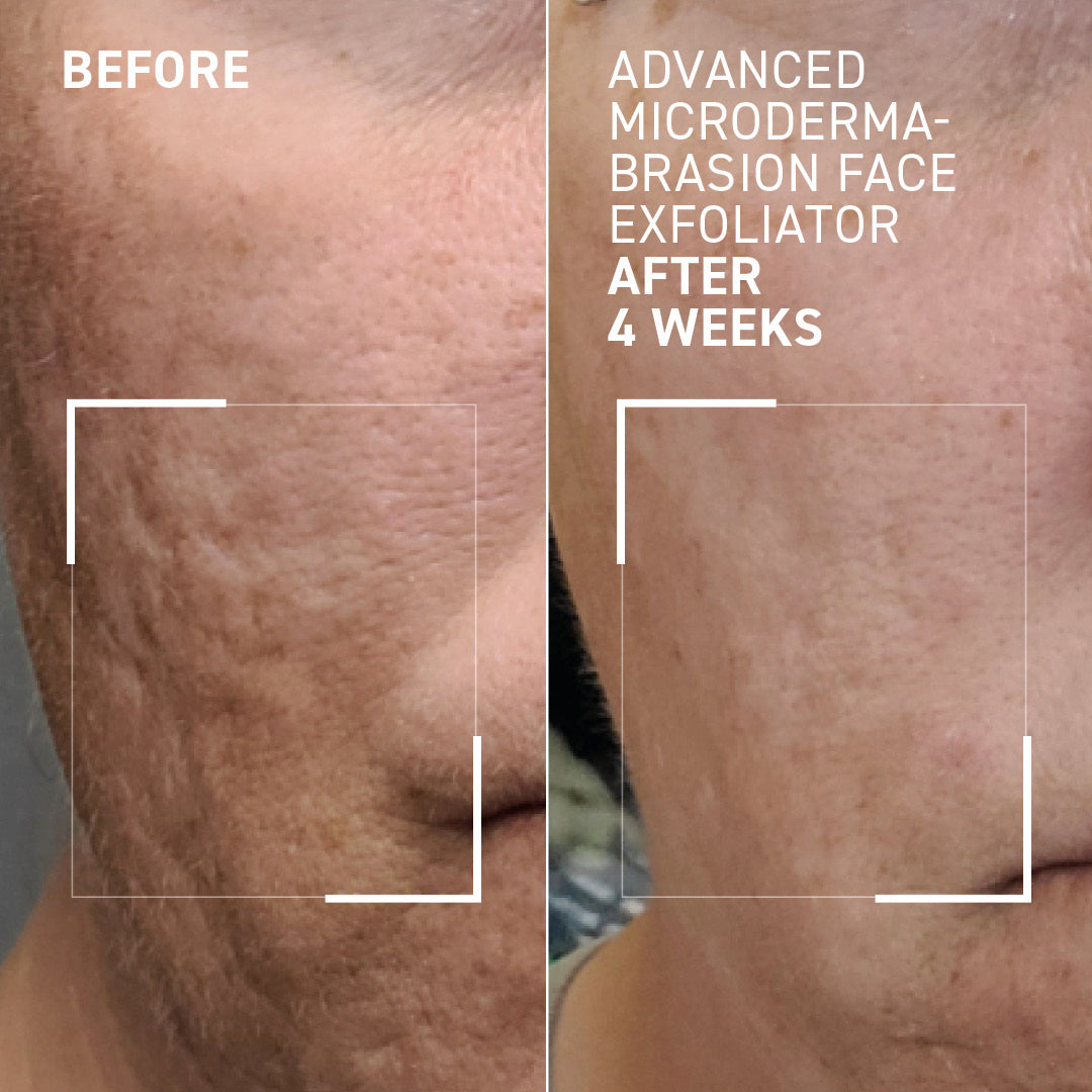 Advanced Microdermabrasion Face Exfoliator