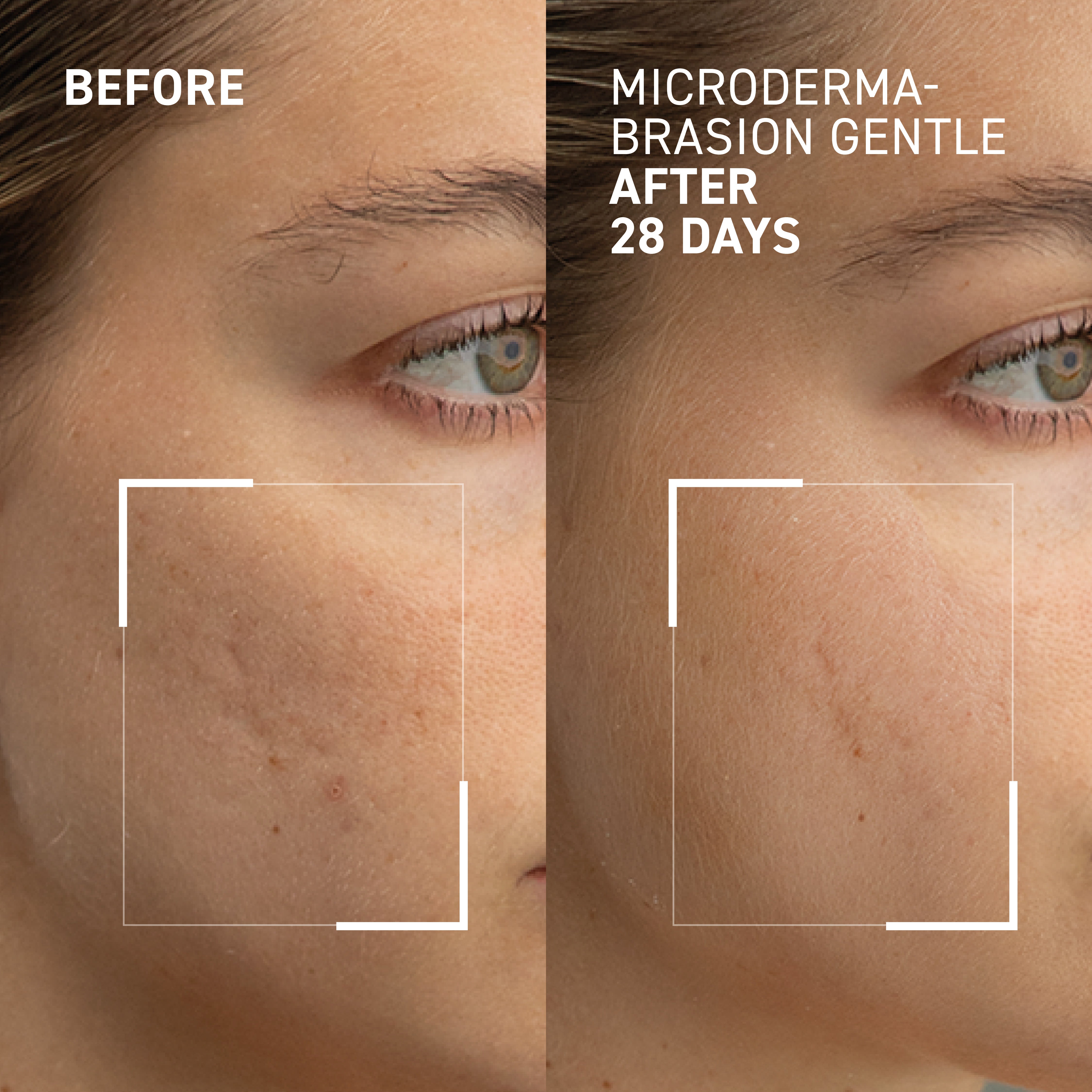 Gentle Microdermabrasion Face Exfoliator