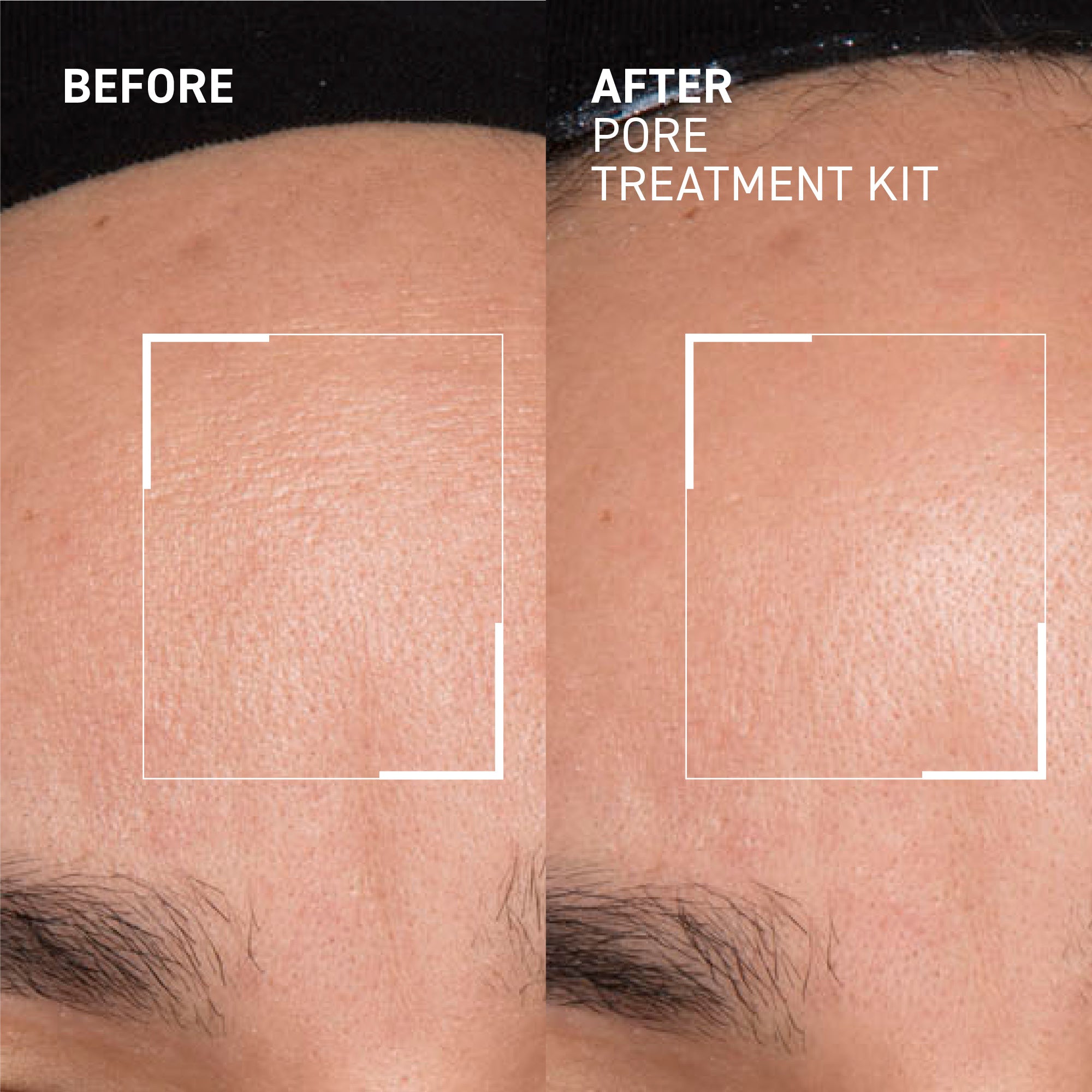Pore Refining Treatment Kit