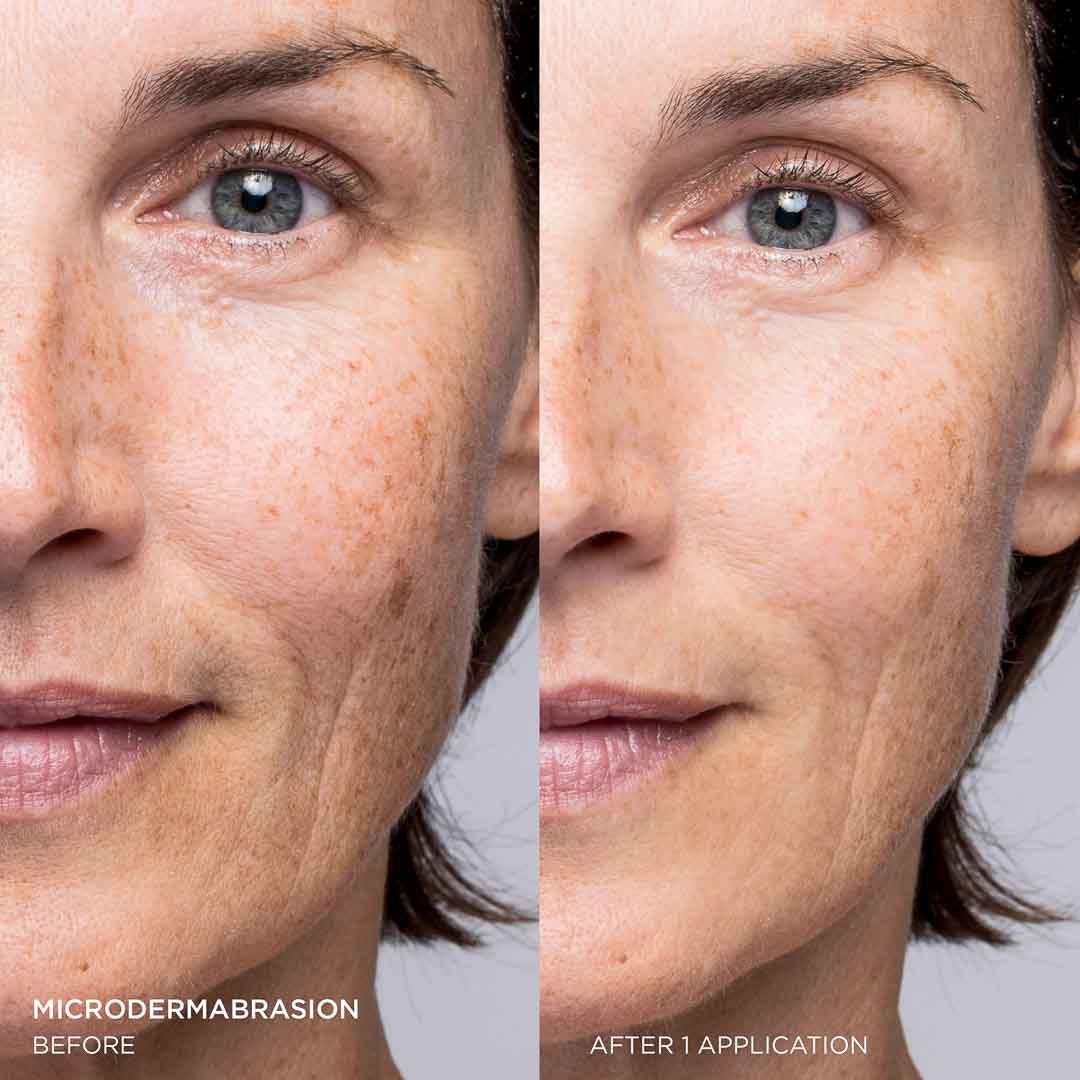 Microdermabrasion Exfoliants Before After