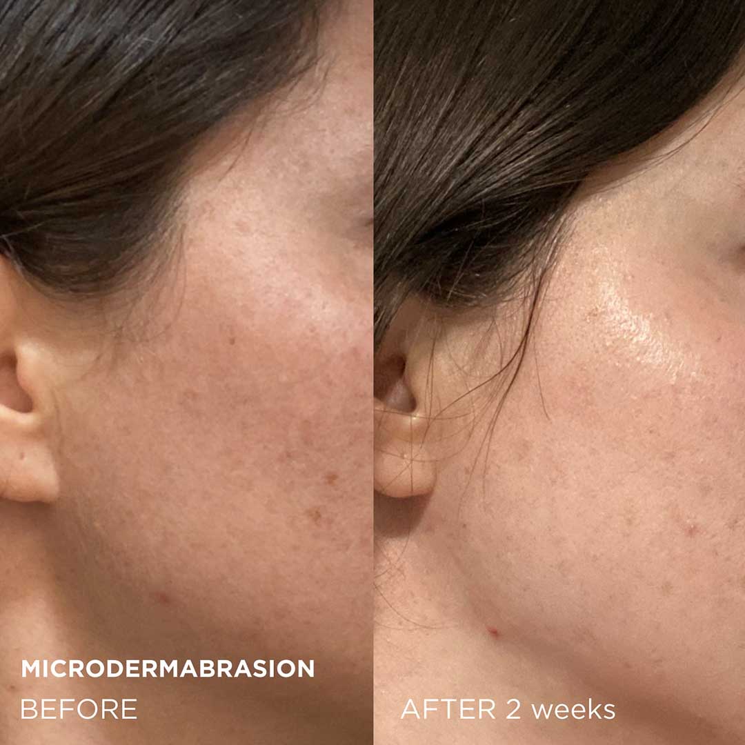 Microdermabrasion  Exfoliants Before After 2